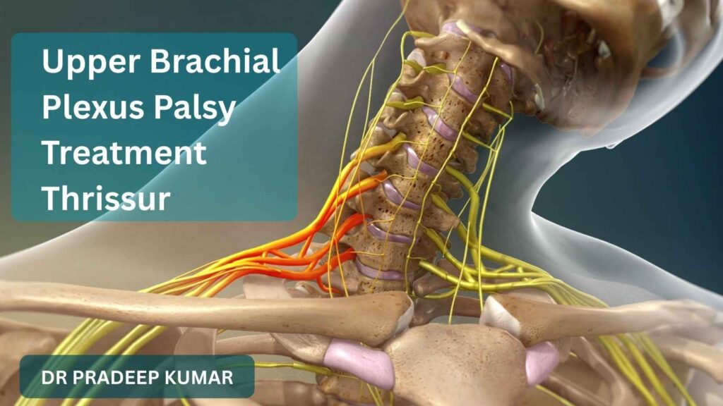 Upper brachial plexus palsy treatment in Thrissur using advanced microsurgical nerve reconstruction.