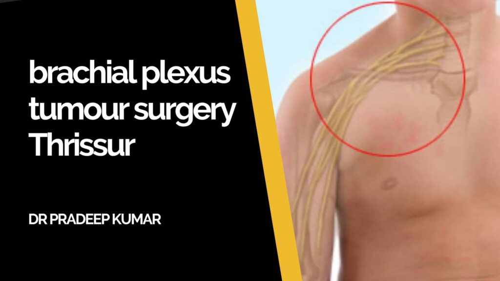 Brachial plexus tumour surgery illustration showing nerve anatomy and surgical precision in Thrissur.