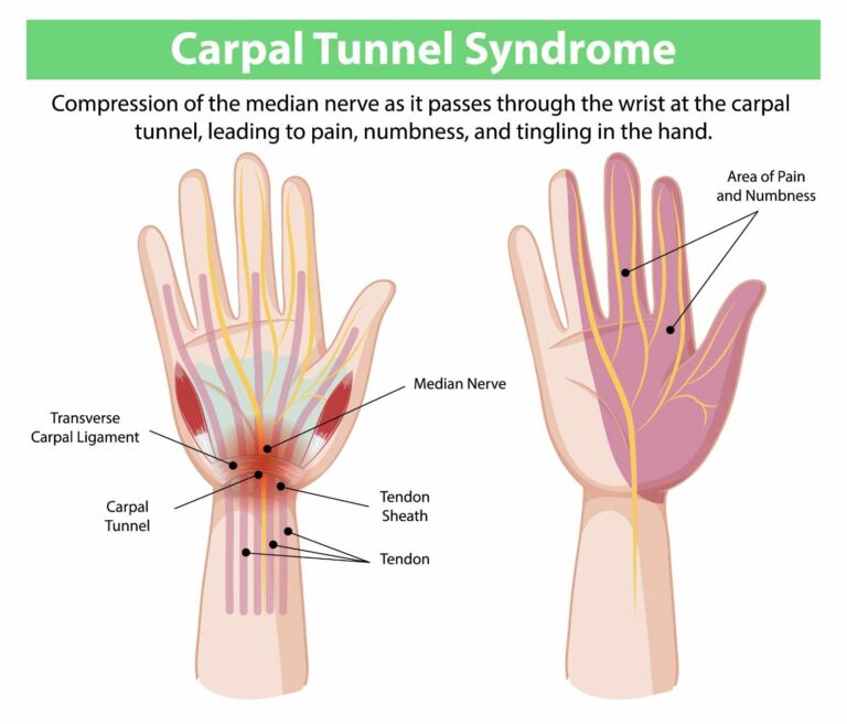 Treatment approaches for carpal tunnel syndrome