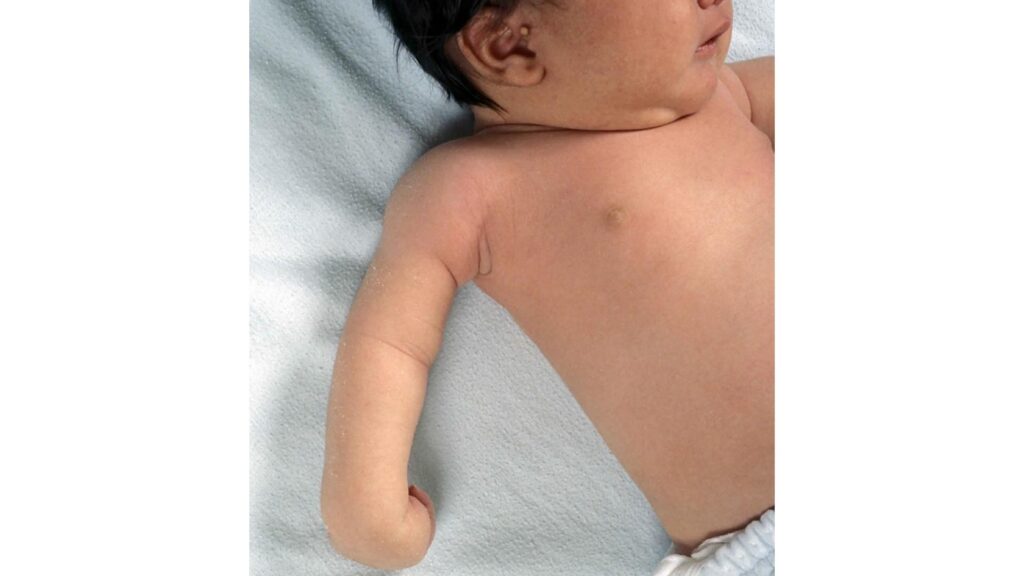 Erb’s Palsy Surgery Risks in Kerala