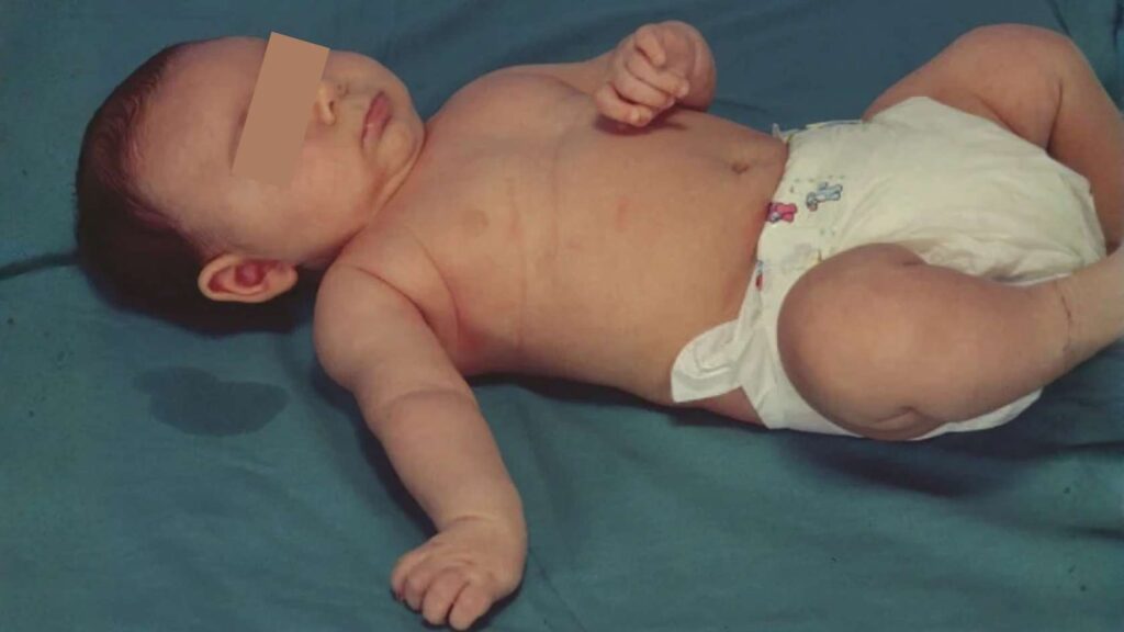Erb’s palsy in infant showing arm weakness and nerve injury condition
