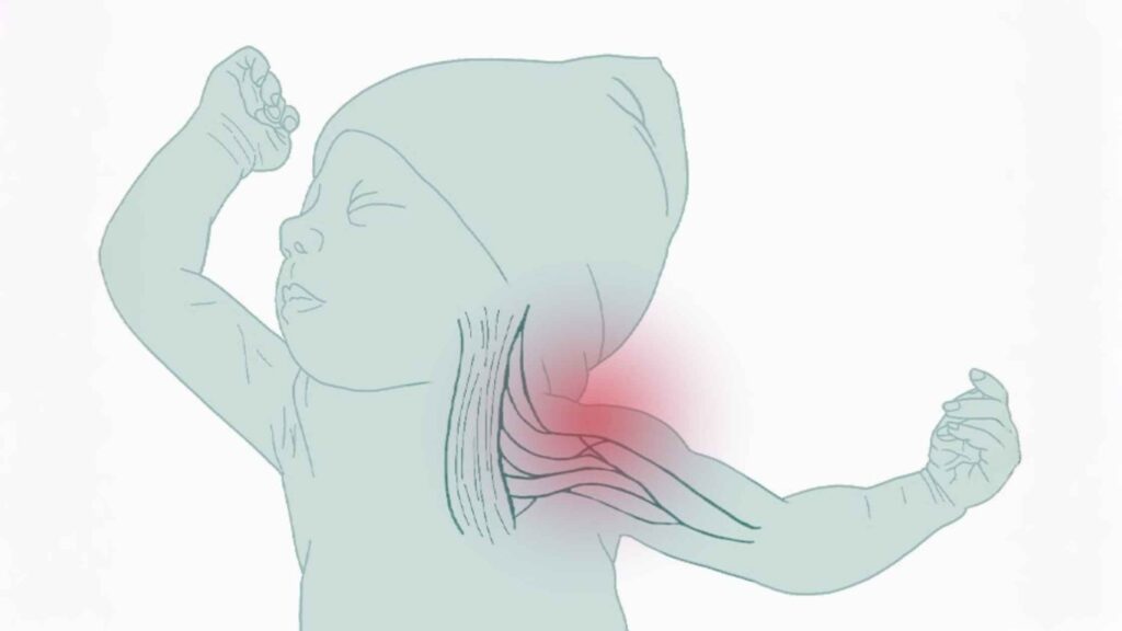 Illustration of a baby with Erb’s palsy showing nerve injury in the shoulder and neck area