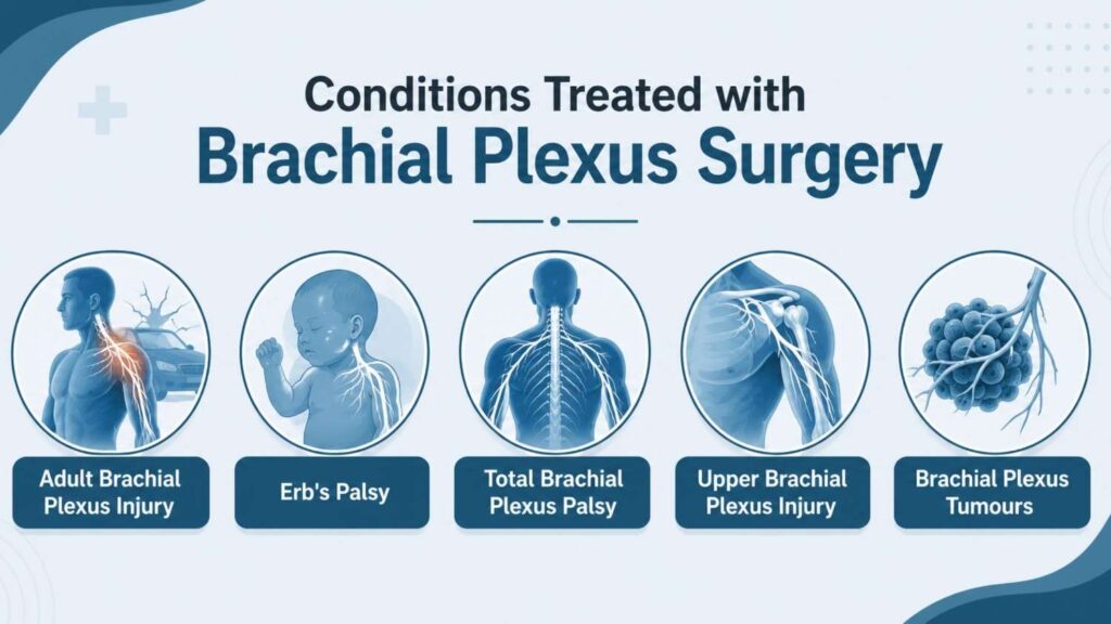 Conditions treated with Brachial Plexus Surgery in Thrissur infographic featuring Adult Brachial Plexus Injury, Erb's Palsy, Total Brachial Plexus Palsy, Upper Brachial Plexus Injury, and Brachial Plexus Tumours.