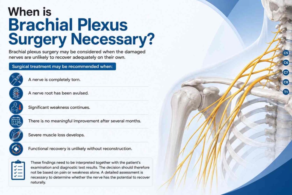 When brachial plexus surgery may be necessary, showing complete nerve tears, nerve root avulsion, persistent weakness, lack of improvement, severe muscle loss, and unlikely functional recovery.