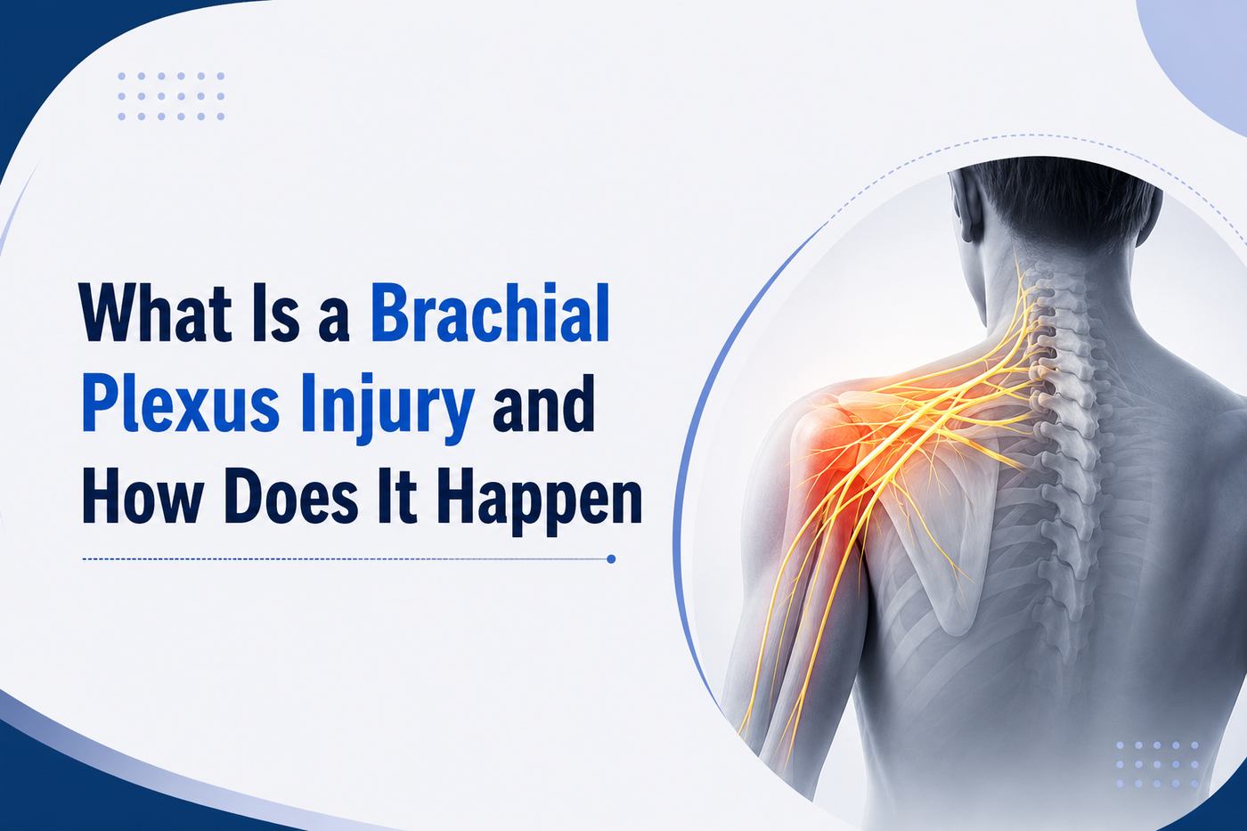 Medical illustration showing a brachial plexus injury affecting the nerves of the shoulder and arm