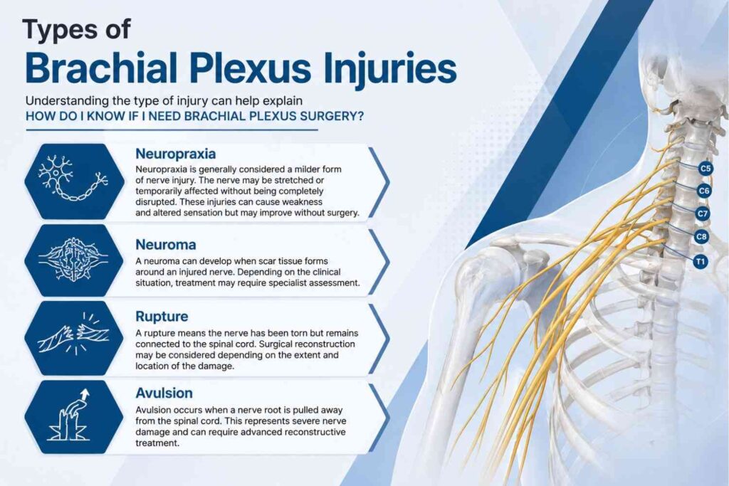 Types of brachial plexus injuries infographic showing neuropraxia, neuroma, rupture, and avulsion with an anatomical illustration of the brachial plexus.